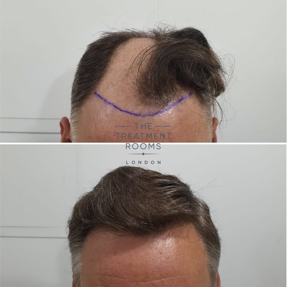 1824 grafts fue hair transplant london.jpg