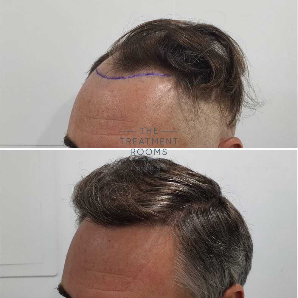 1824 grafts hair transplant before and after.jpg