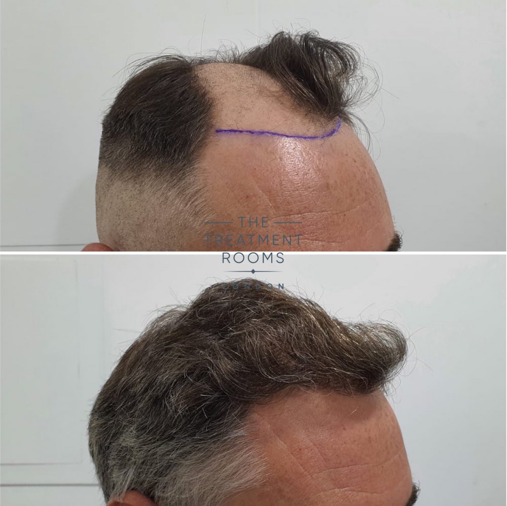 1824 grafts hair transplant hairline before and after.jpg