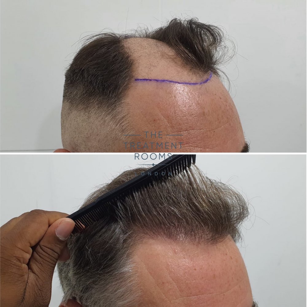 1824 grafts hair transplant result.jpg