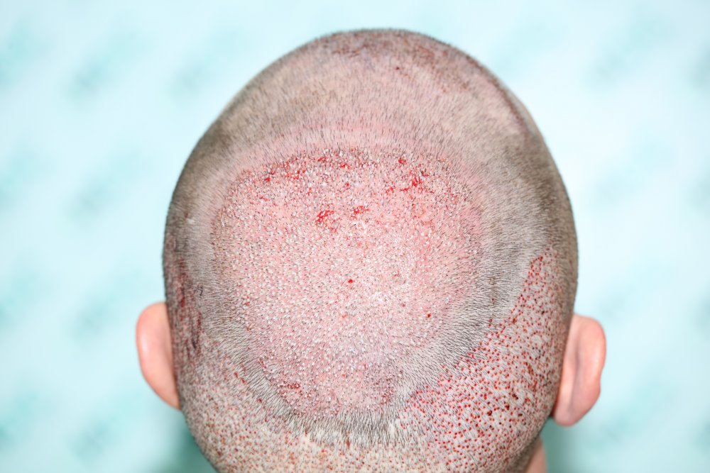 19 -2850 grafts to crown for FUE2.JPG