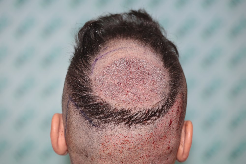 2. 1st day 1600 grafts.JPG