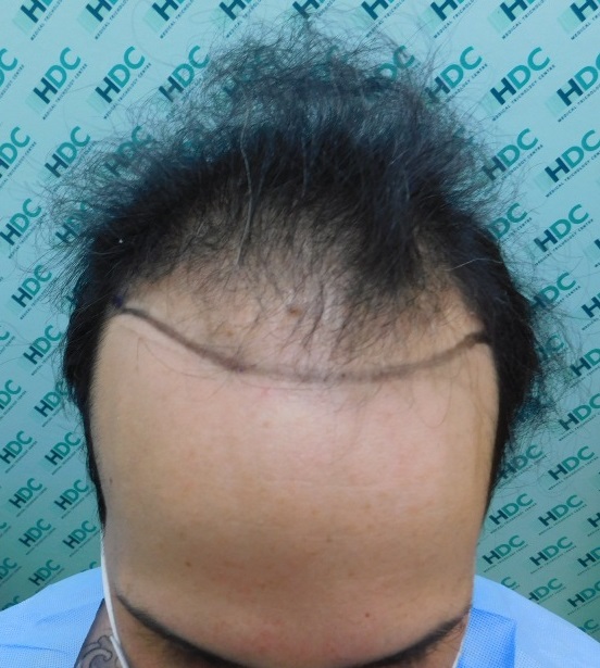 2. Before Front.JPG