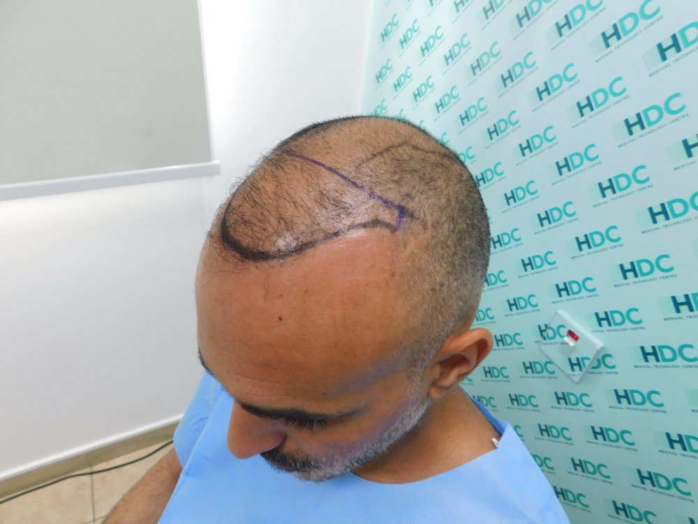 2. Before FUE1 with design.JPG