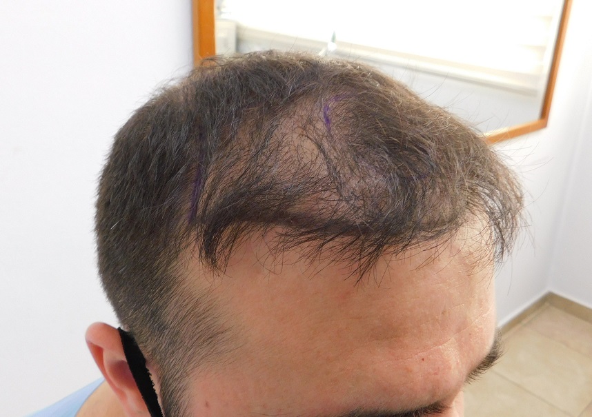 2. Before Right.JPG