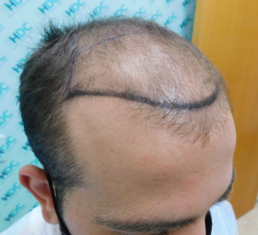 2. Before - right.JPG