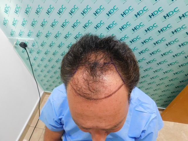 2. Clear photo before FUE1.jpg