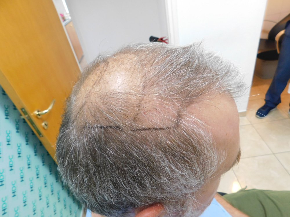 2. Connect top hair with donor - Right.JPG