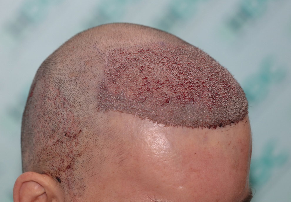2. Post op 3800 Grafts - Recipient.JPG