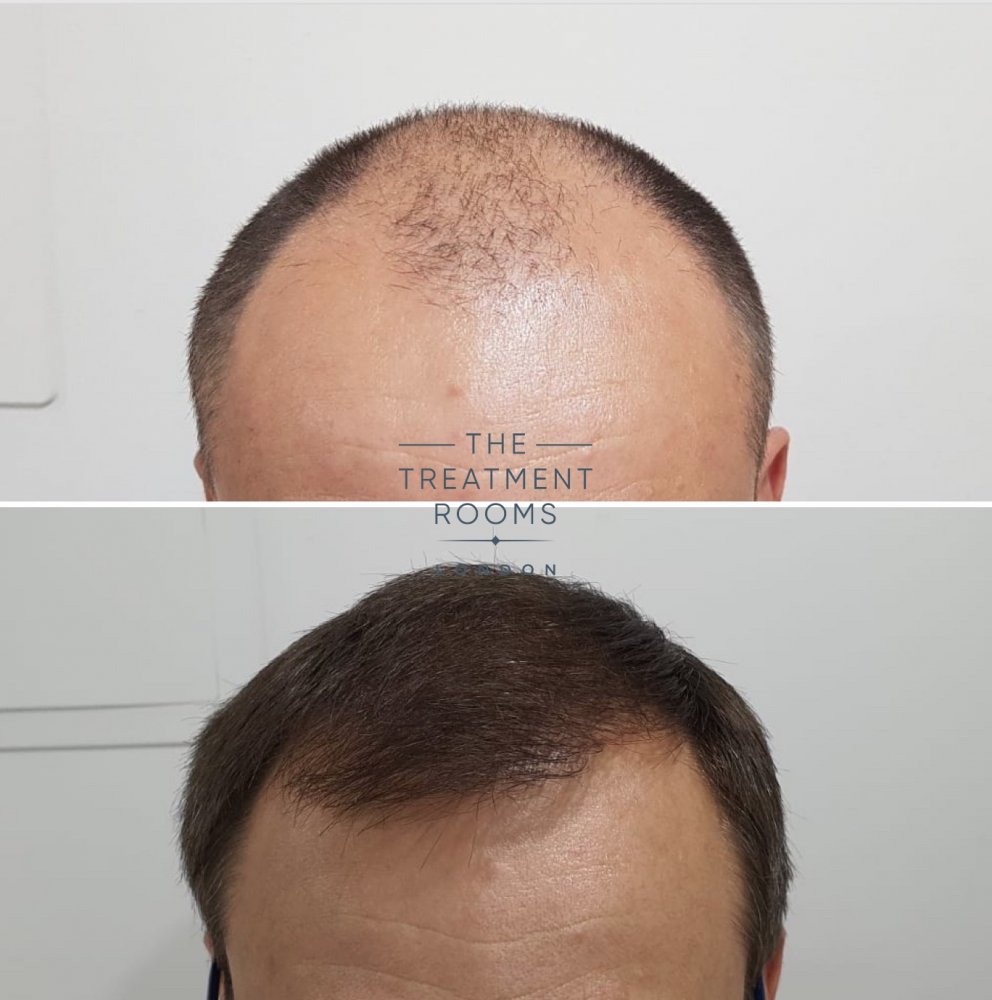 2000 graft FUE hair transplant hairline before and after.jpg
