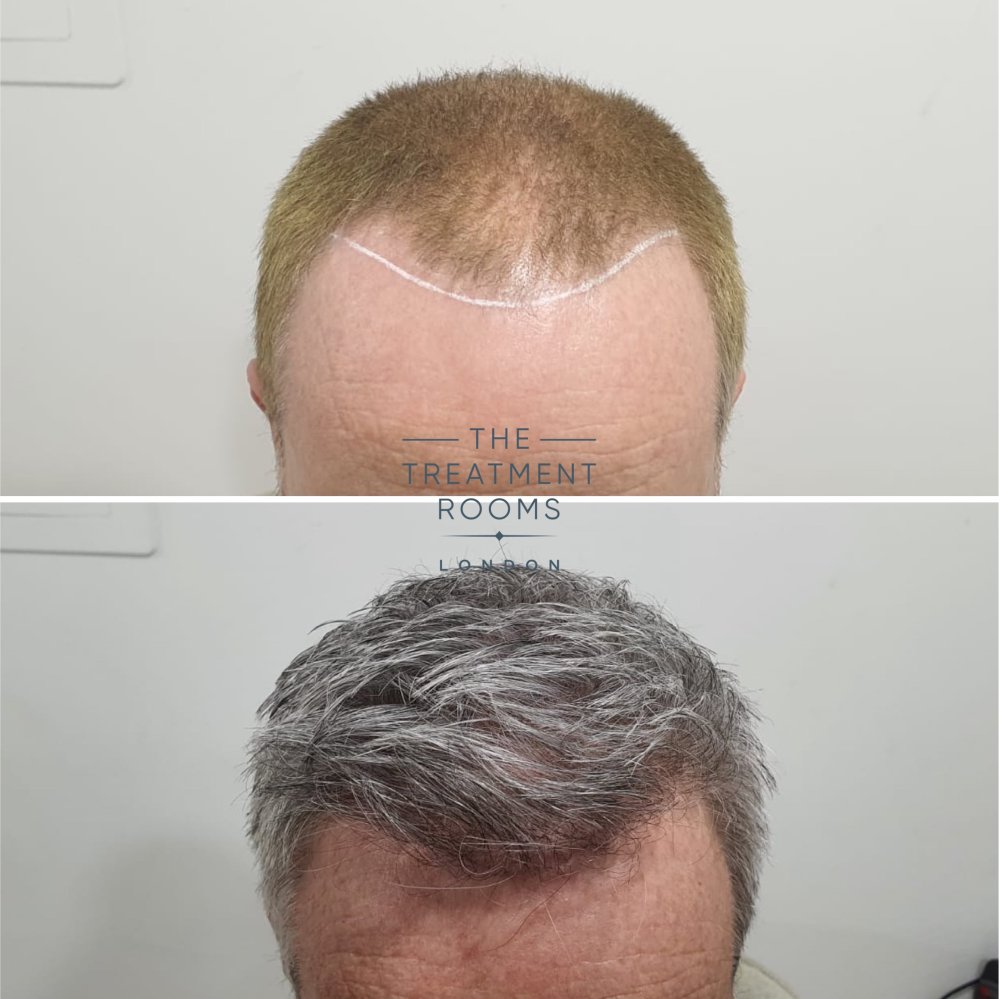 2322 graft fue hair transplant hairline and crown result.jpg