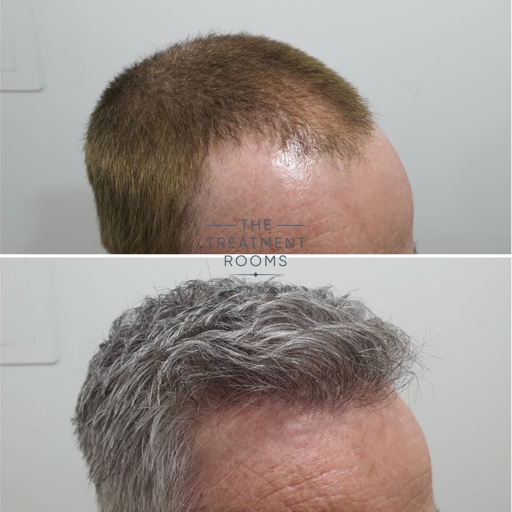 2322 graft fue hair transplant london result.jpg