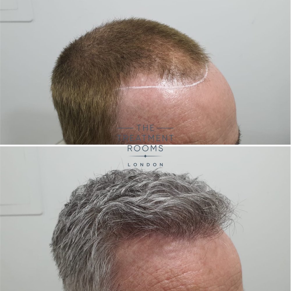2322 graft fue hair transplant result.jpg