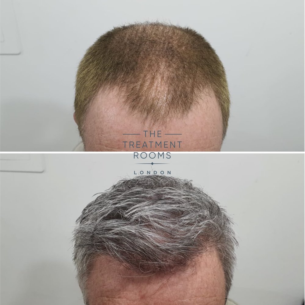 2322 graft fue hairline transplant result.jpg