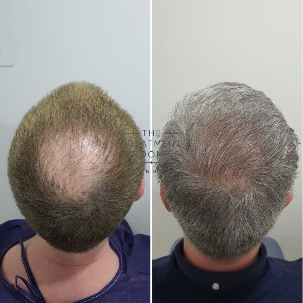 2322 graft hair transplant result.jpg