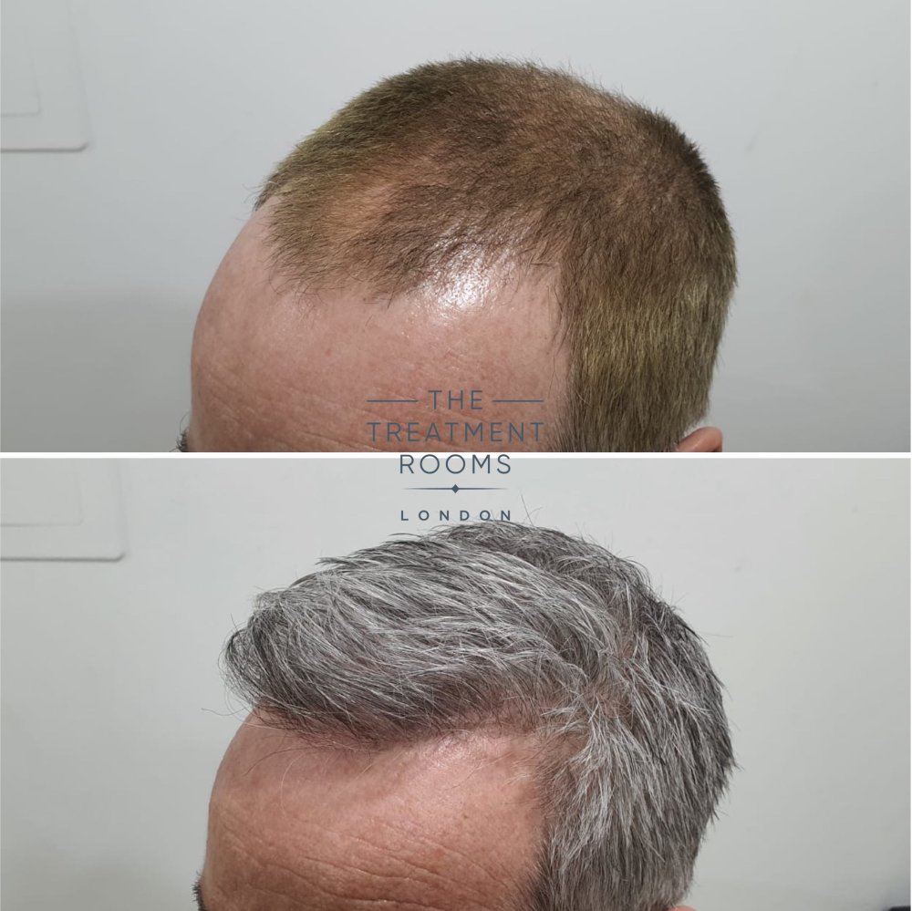 2322 graft hairline transplant result.jpg