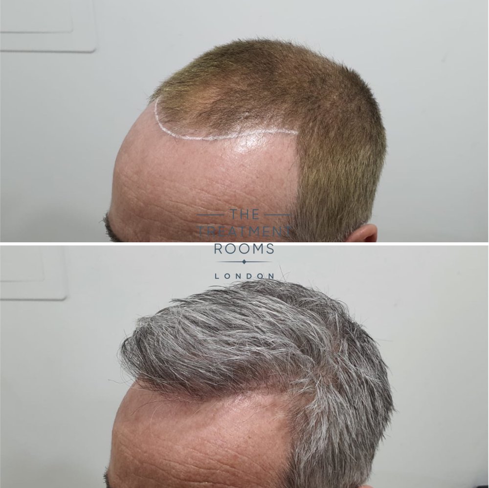 2322 graft result.jpg