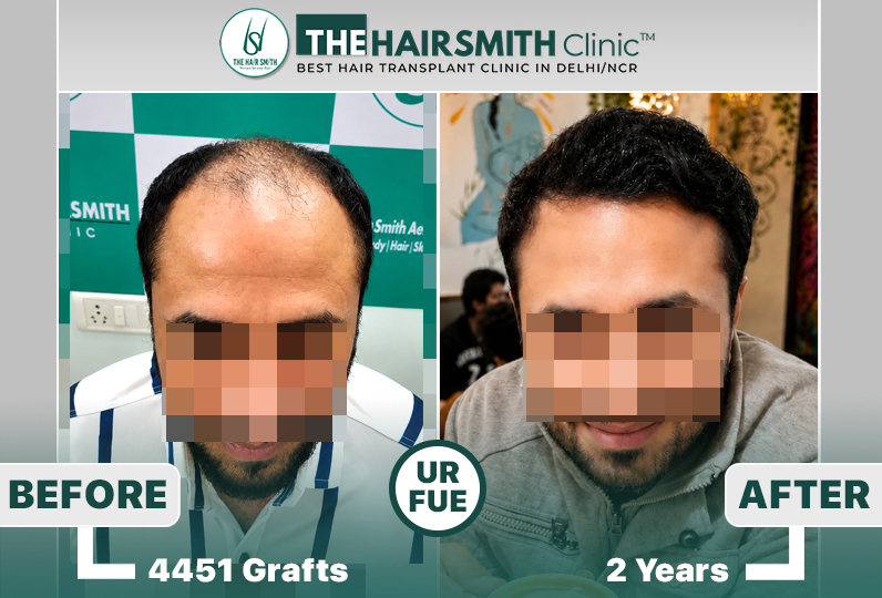 24 months hairsmith hair transplant result - The Hairsmith Clinic - #HairTransplant #The Hairm...JPG