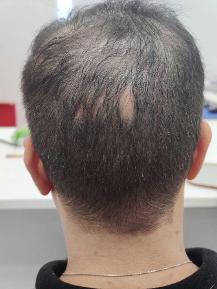 2a. Back donor before.jpg