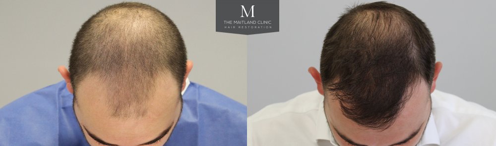 2Before_After_Front_top.jpg
