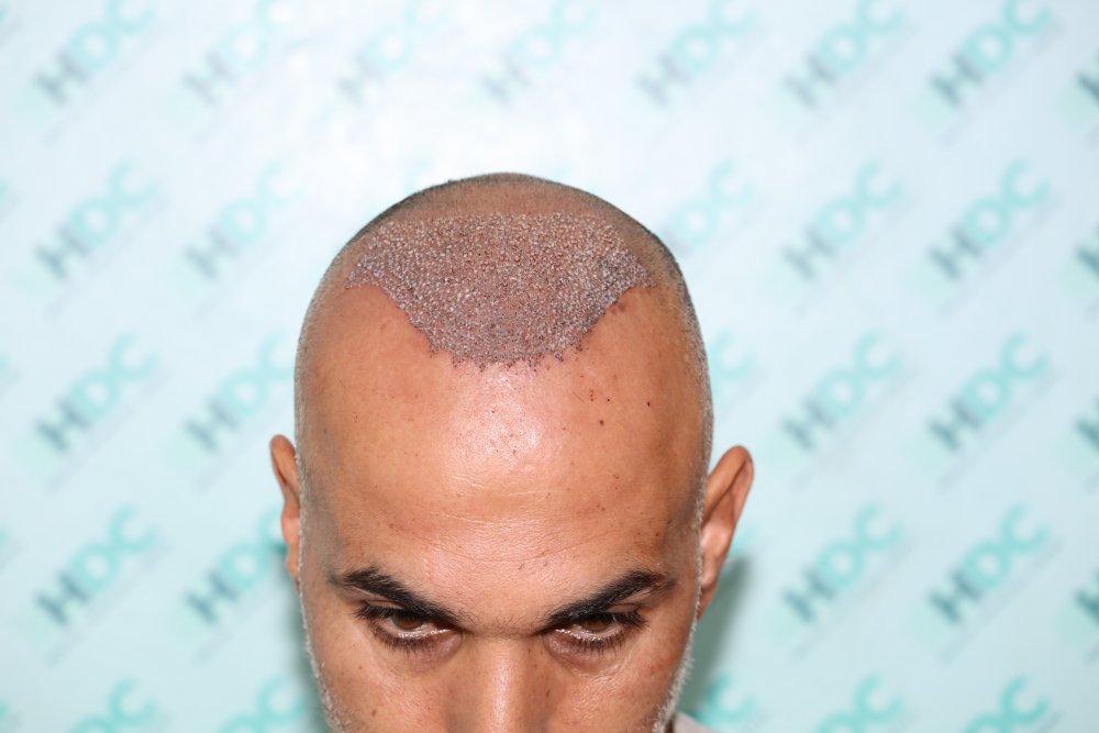 3. 2325 grafts on 11-08-21.JPG