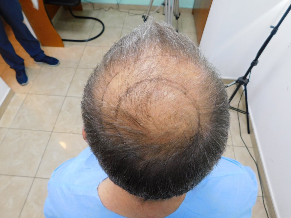 3. Add hair to top area and leave crown for FUE2.JPG
