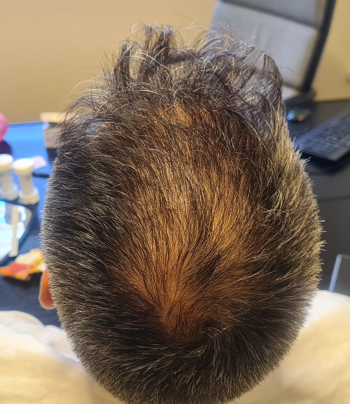 3. Before Crown back View.jpg