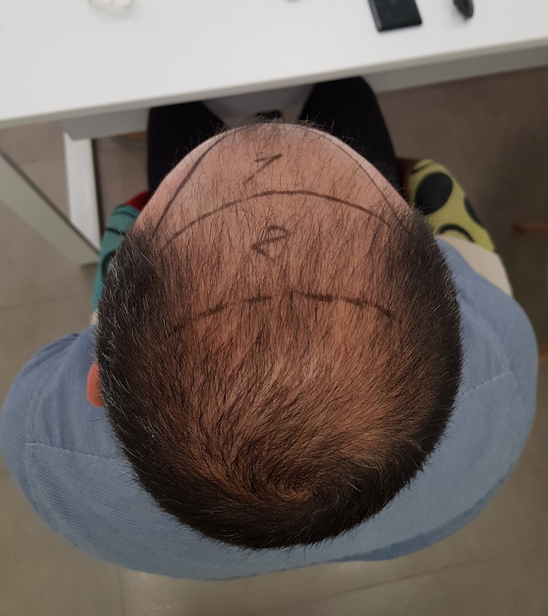 3 - Before FUE1 - Top Back View.jpg