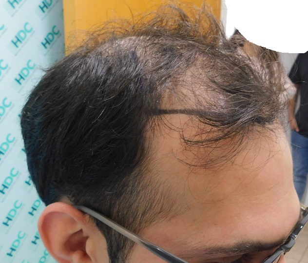 3. Before Right.JPG