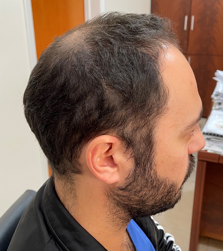 3. donor Before 2 FUE.jpg