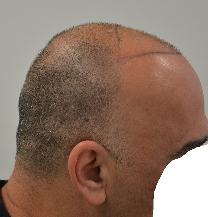 3. Donor Before Right.JPG