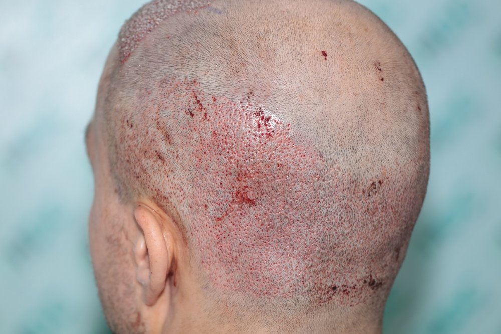 3. donor post op - Left.JPG