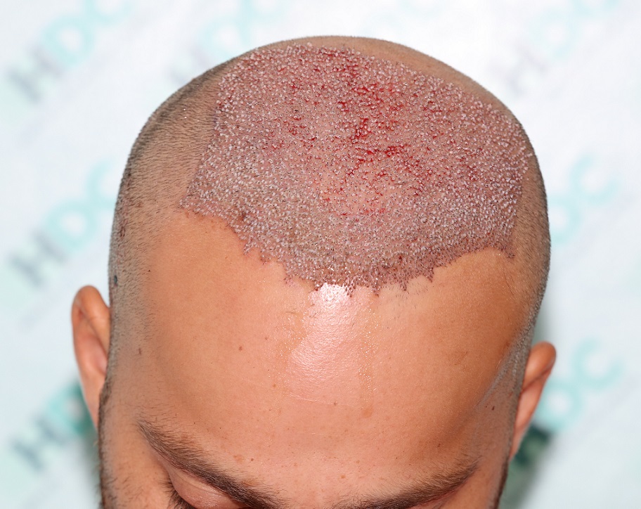 3. FUE1 - post op 3878 grafts on 24-09-20.JPG