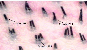3 hair follicular unit.jpg