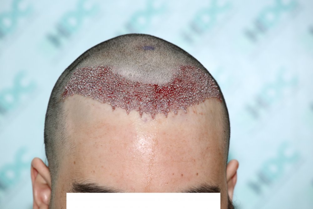 3- Post op 2352 grafts.JPG