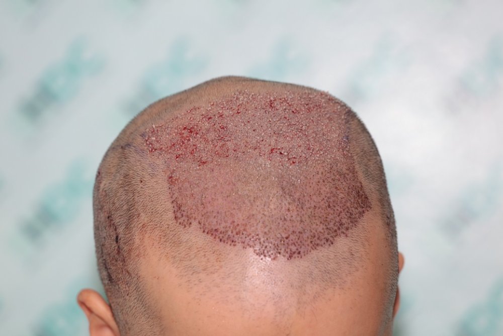 3. post op - 3416 Grafts on 17-06-22.JPG
