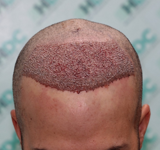 3. Post op 4000 Grafts.JPG