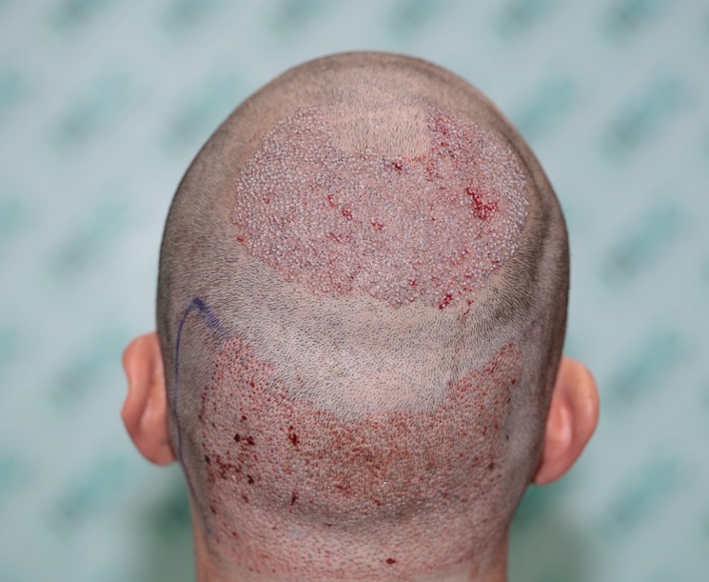 3. Post op for 2400 Grafts on 29-09-22 (2).JPG