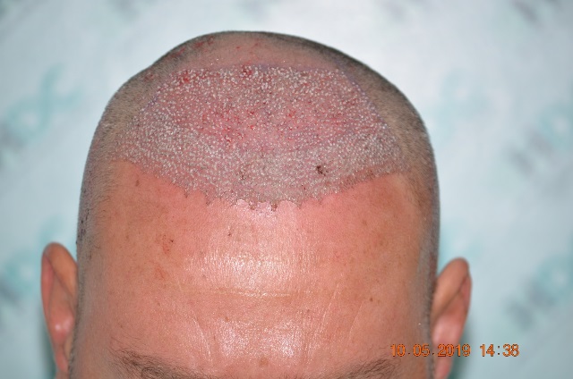 3. Post op FUE1 2900 Grafts.JPG