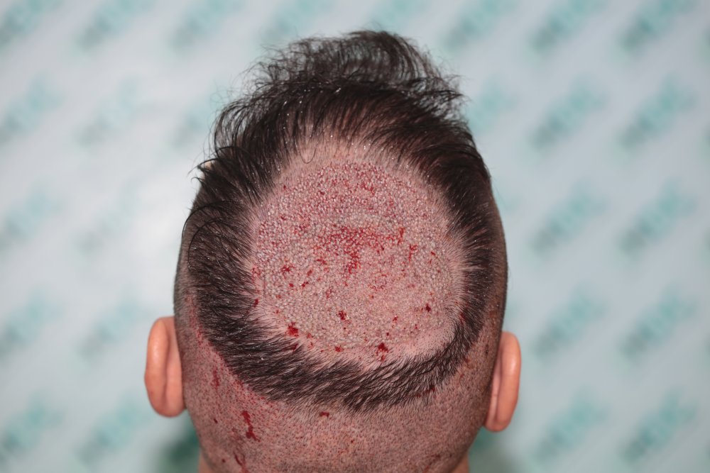 3. Post op on 06-11-23 for 1600 + 810 =  2410 grafts.JPG
