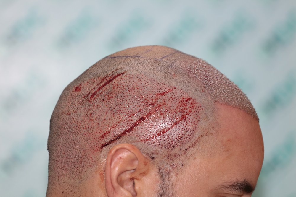 3. Post op right.JPG