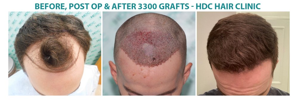3300 grafts set 1.jpg
