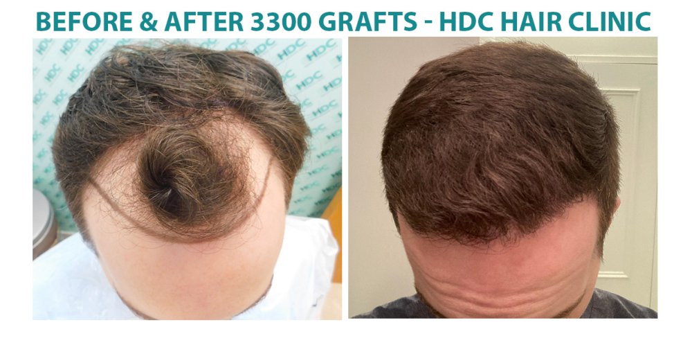 3300 grafts set 2.jpg