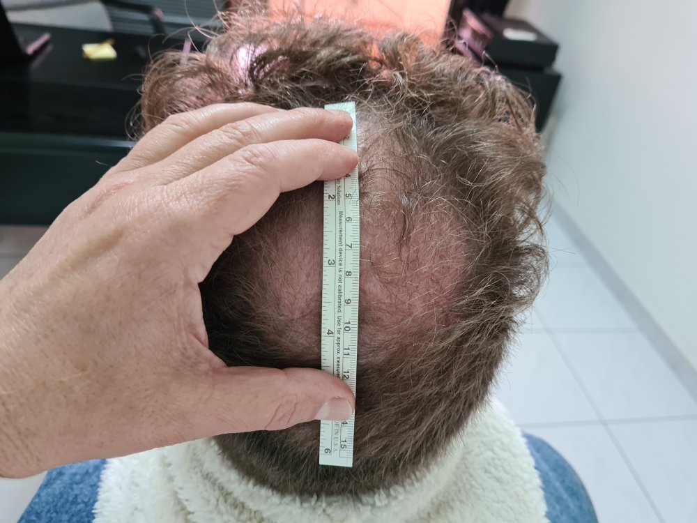3a. Before FUE2 - Crown length.jpg