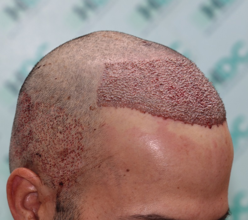 3a. Post op Right.JPG