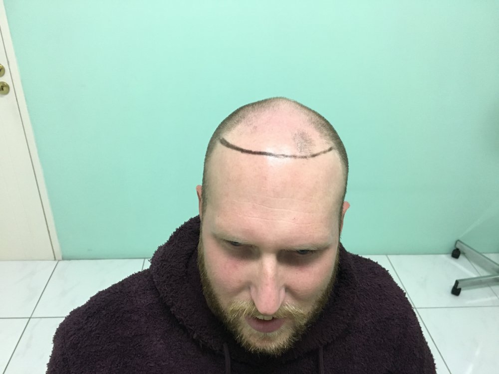 3aa. Before full face.JPG