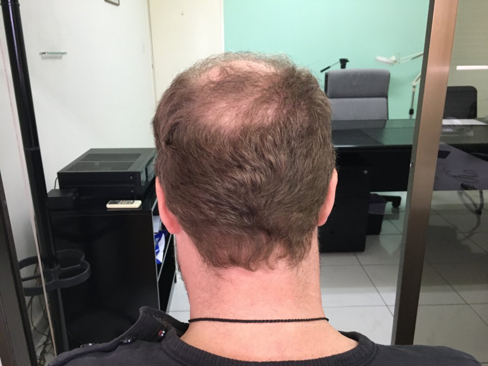 3c. donor after FUE1.JPG