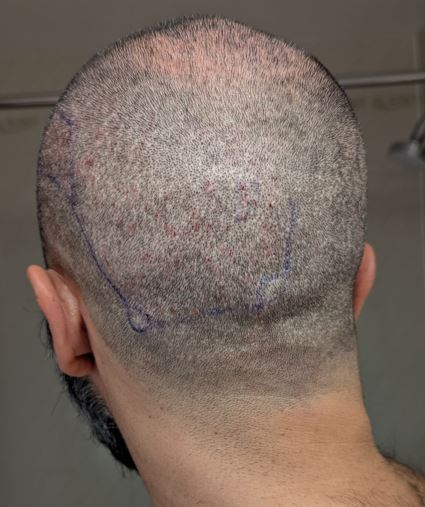 3rd repair back_post-op.JPG