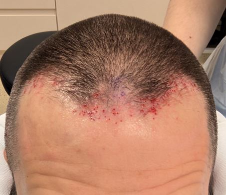 3rd repair center_post-op.JPG