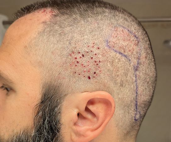 3rd repair left side_post-op.JPG